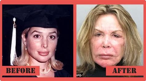 death by plastic surgery